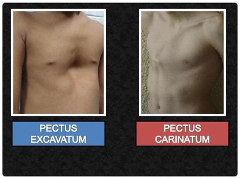 Pectus excavatum - pohľad na hrudník dieťaťa