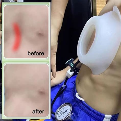 Vacuum bell terapia na liečbu pectus excavatum