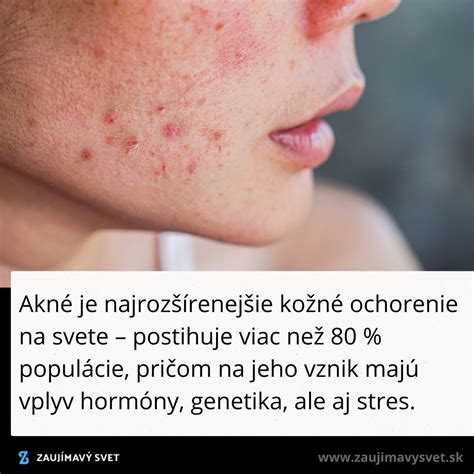 Schéma vzniku akné: upchávanie pórov, tvorba mazu a baktérie