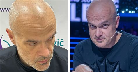 Schéma rizík a komplikácií po transplantácii vlasov