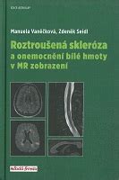 Zobrazenie demyelinizácie pri roztrúsenej skleróze