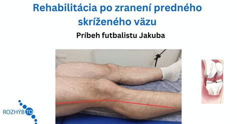 Príčiny natrhnutia predného skríženého väzu