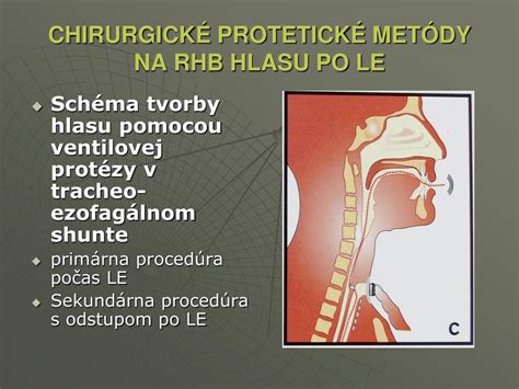 Schéma tracheostómie