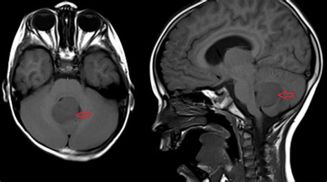 MRI snímka miechového nádoru