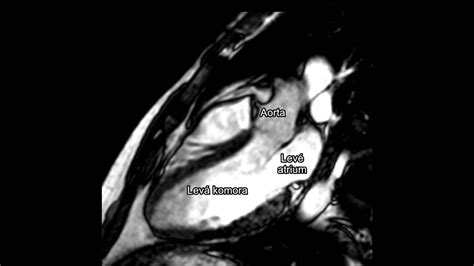 MRI srdca