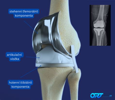 Infografika zobrazujúca postup rehabilitácie po TEP kolena