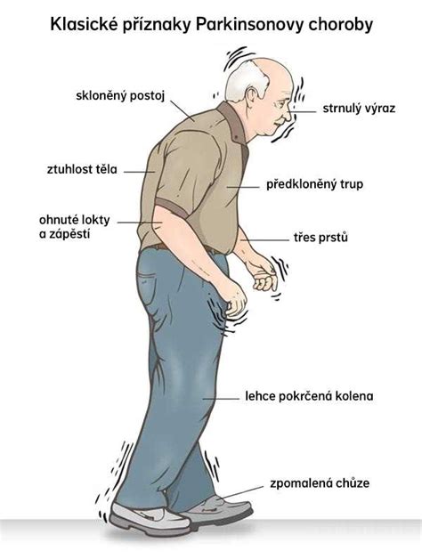 Infografika: Parkinsonova choroba a jej vplyv na mozog