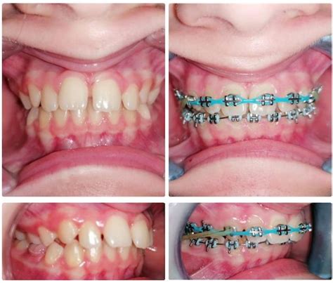 Porovnanie Invisalign a tradičného strojčeka