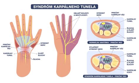 Ruka s vyznačeným karpálnym tunelom a stredným nervom