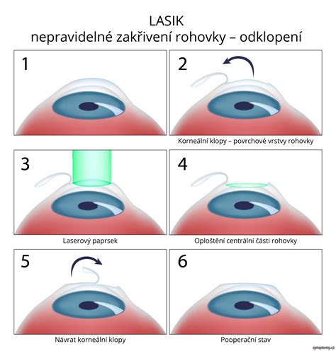 Schéma vrstiev rohovky a princípu LASIK