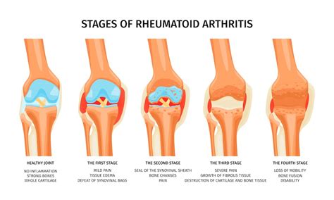 Ilustrácia kĺbov postihnutých reumatoidnou artritídou