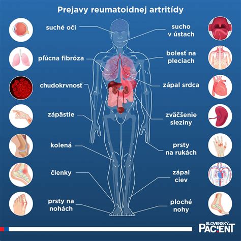 Infografika zobrazujúca bežné príznaky reumatoidnej artritídy