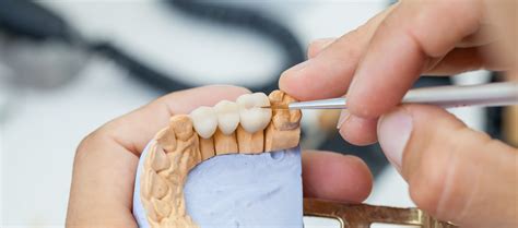 Vizualizácia konštrukcie zubného mostíka s pilierovými korunkami a medzičlenmi