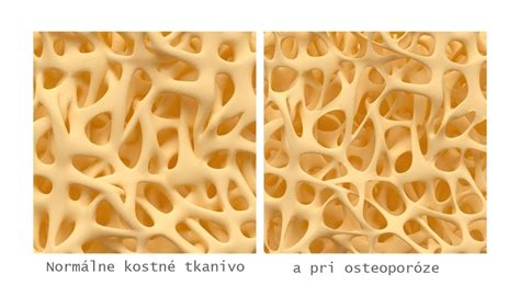Štruktúra kosti a proces obnovy kostného tkaniva pri osteoporóze