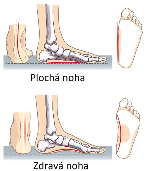 Deformity chodidla spojené s osteoporózou: ploché nohy, hallux valgus, kladivkové prsty