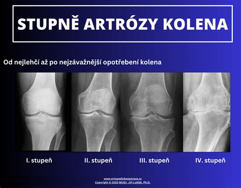 Schéma vzniku a progresie artrózy kolena