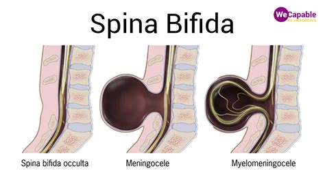 Typy spina bifida: occulta, meningokéla, myelomeningokéla