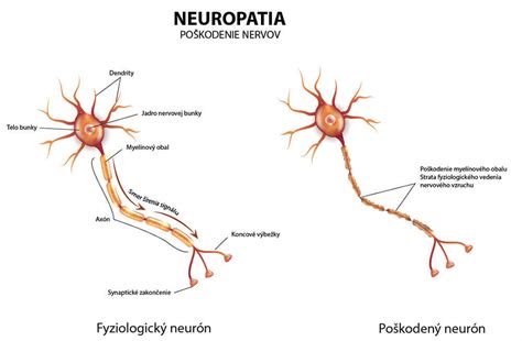 Infografika: Príznaky diabetickej neuropatie na dolných končatinách
