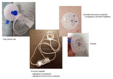Schéma inzulínovej pumpy s kanylou a zásobníkom