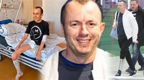 Pacient s amputovanou nohou a protézou