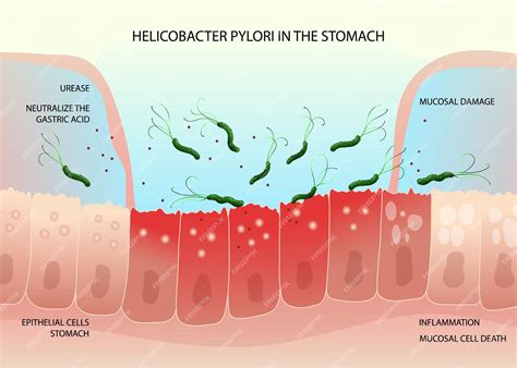 Infekcia Helicobacter pylori a jej vplyv na vznik vredov