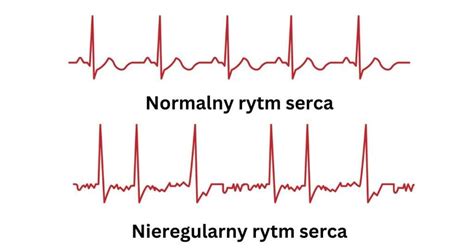 Srdcová arytmia - porucha srdcového rytmu