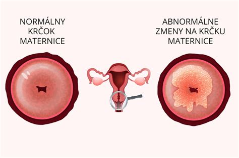 Fyziologický stav a abnormálne zmeny tkaniva krčka maternice