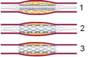 Ilustrácia priebehu angioplastiky so zavedením stentu