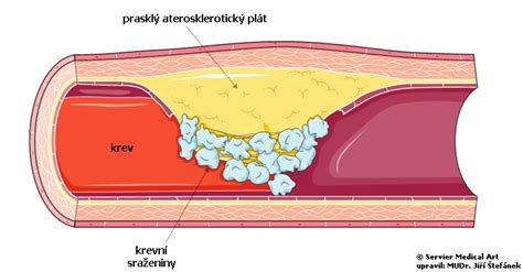 Aterosklerotický plát v tepne