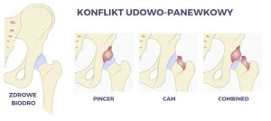 Typy femoroacetabulárneho impingementu