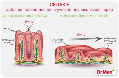 Ilustrácia príznakov celiakie