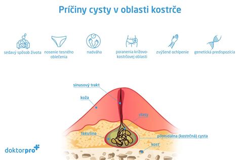 Príznaky Tarlovovej cysty