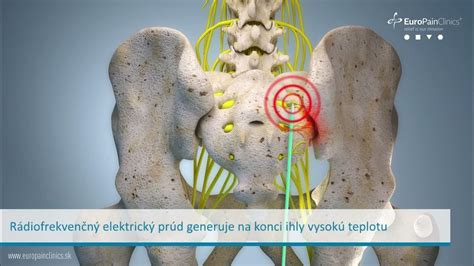 Rádiofrekvenčná ablácia - schéma