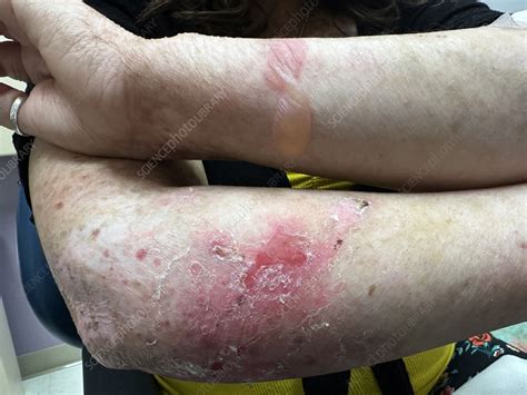 Ilustrácia rôznych typov Epidermolysis Bullosa na koži