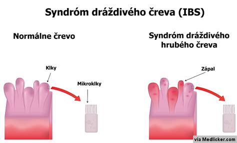Schéma diagnostiky syndrómu dráždivého čreva