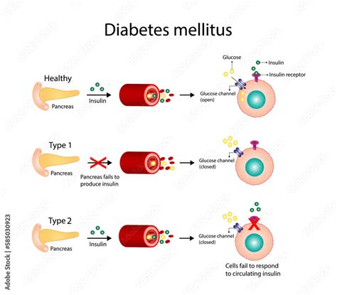 Infografika porovnávajúca diabetes mellitus typu 1 a 2