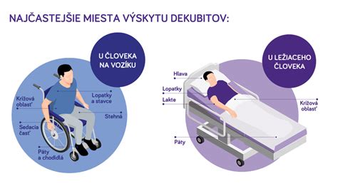 Schéma vzniku preležanín pri dlhodobom tlaku