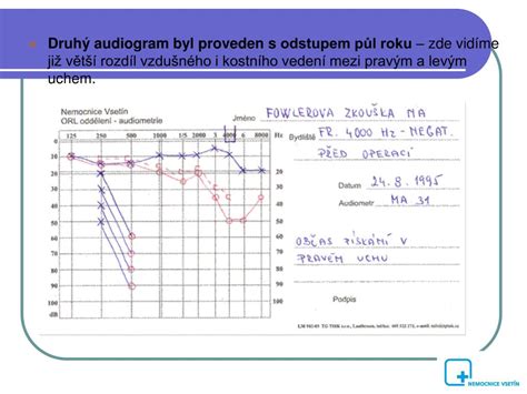 Audiometrické vyšetrenie
