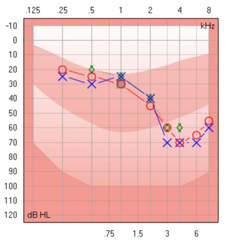 Audiogram znázorňujúci rôzne stupne sluchového postihnutia
