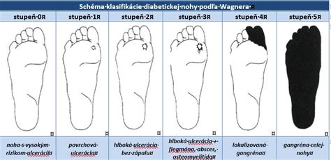 Prienik diabetickej nohy s typickými prejavmi
