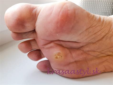 Plesňová infekcia na nohe diabetika