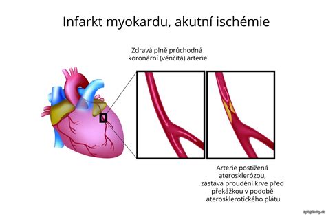 Srdce a graf znázorňujúci riziká infarktu