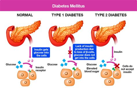 Rozdiel medzi diabetes mellitus 1. a 2. typu