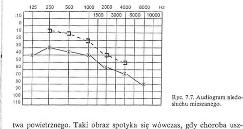 Príklad audiogramu s vyznačenými značkami