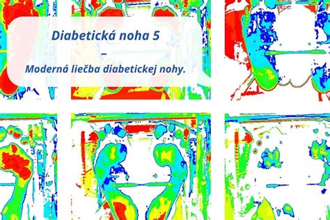 Schéma: Možnosti liečby diabetickej nohy (konzervatívna, chirurgická)