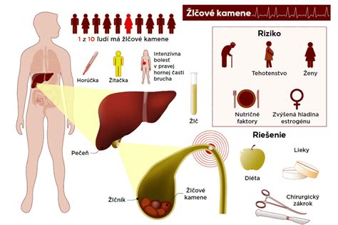 Infografika zobrazujúca hlavné príznaky ileu