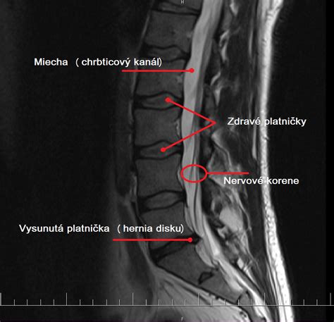 Ukážka MRI snímky chrbtice s diagnostikovanou spinálnou stenózou