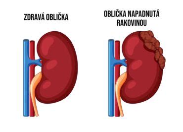 Schéma mechanickej perfúzie obličky