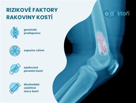 Rizikové faktory zlomenín kostí