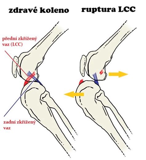 Porovnanie opuchu pri narazení a zlomenine kolena